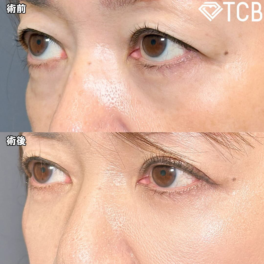 切らない目の下のクマ取り・目の下のたるみ（ふくらみ）取りの症例写真04