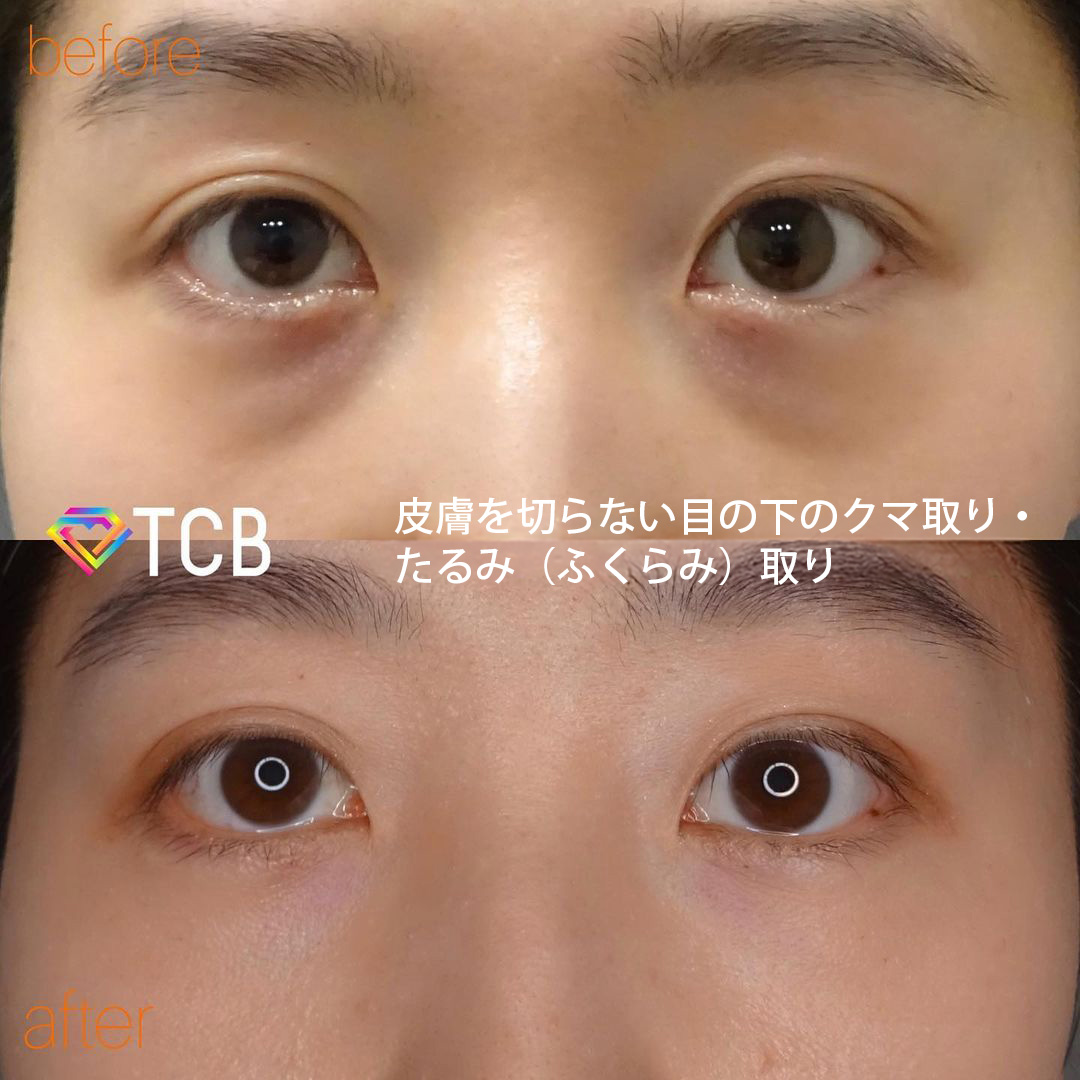 皮膚を切らない目の下のクマ取り・たるみ（ふくらみ）取りの症例写真01