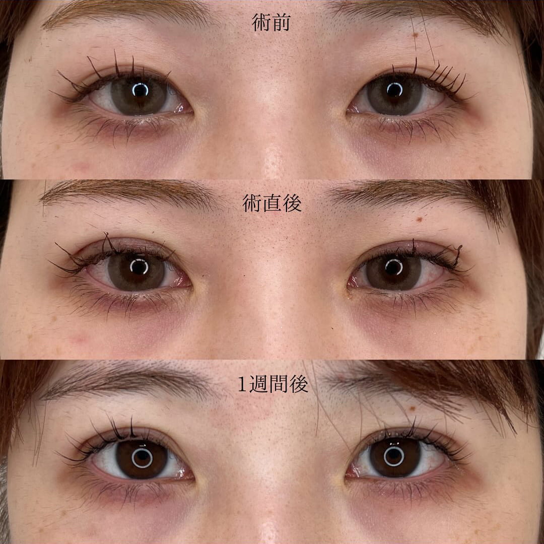 二重埋没の症例写真01