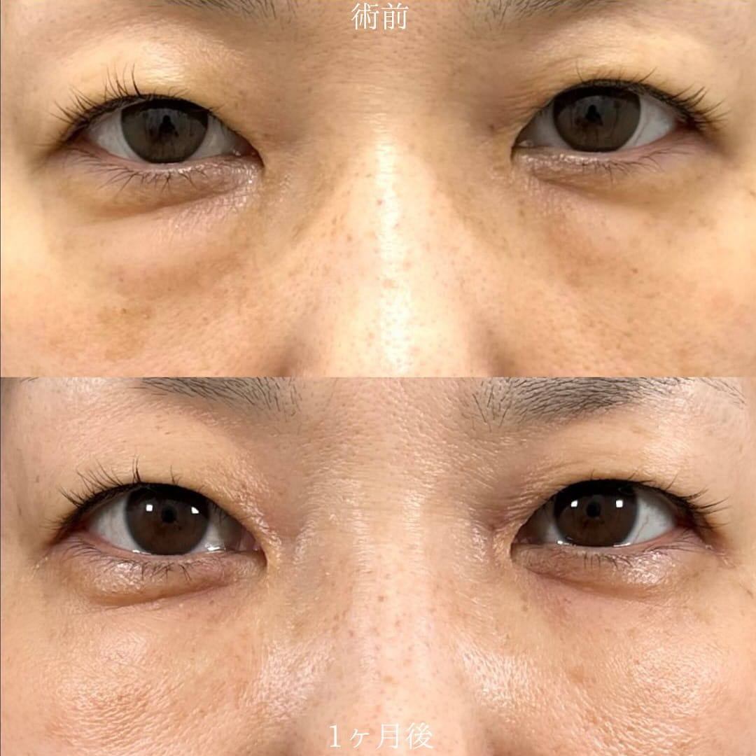 切らない目の下のクマ取り・目の下のたるみ（ふくらみ）取りの症例写真01