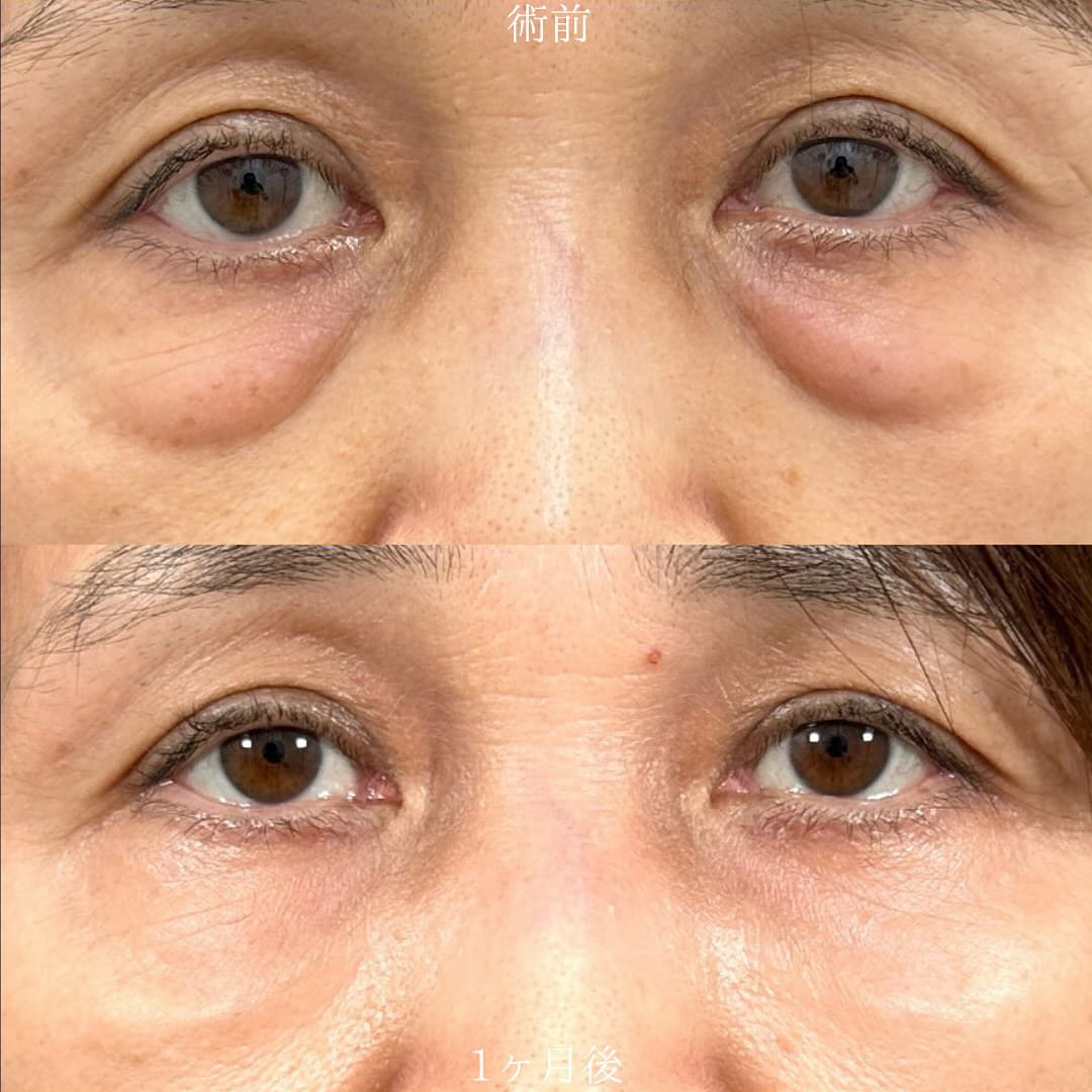 切らない目の下のクマ取り・目の下のたるみ（ふくらみ）取りの症例写真02