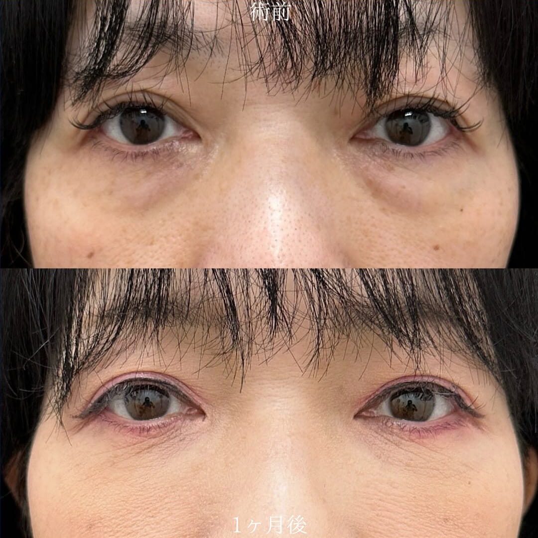 切らない目の下のクマ取り・目の下のたるみ（ふくらみ）取りの症例写真03