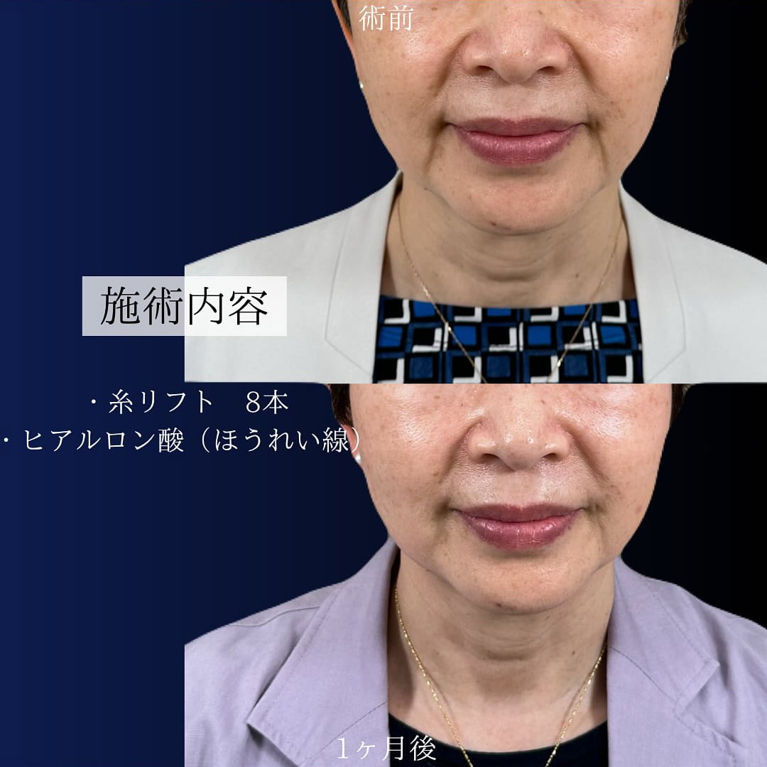 TCB小顔リフト（糸リフト・スレッドリフト）の症例写真02