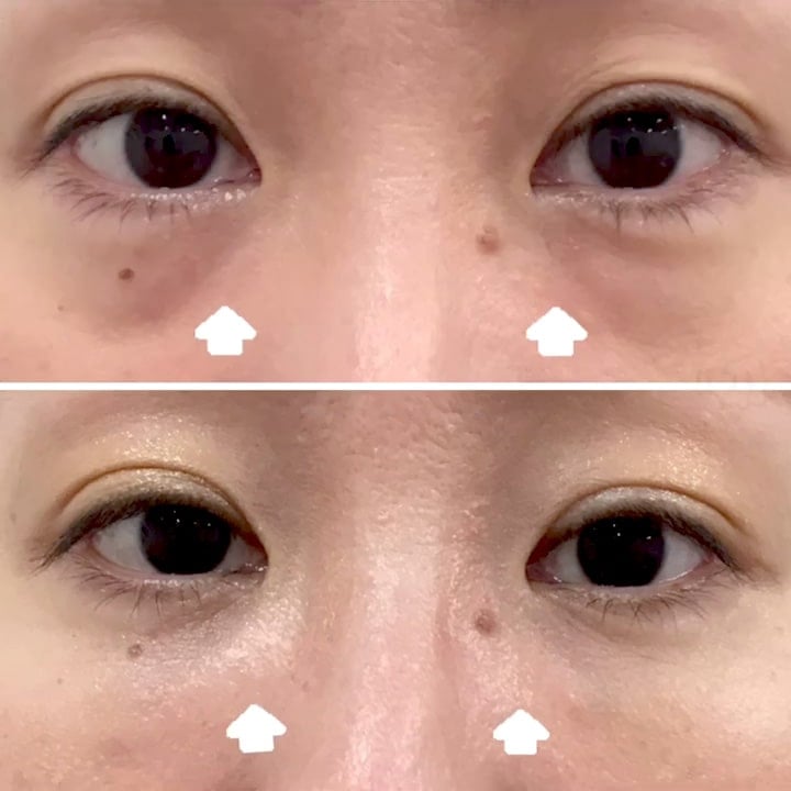 切らない目の下のクマ・たるみ取りの症例写真01