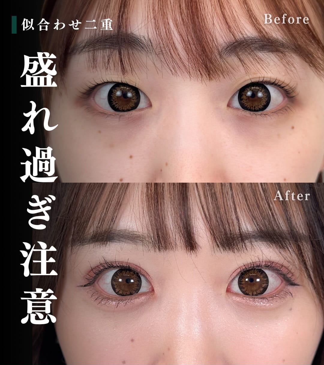 二重埋没の症例写真01