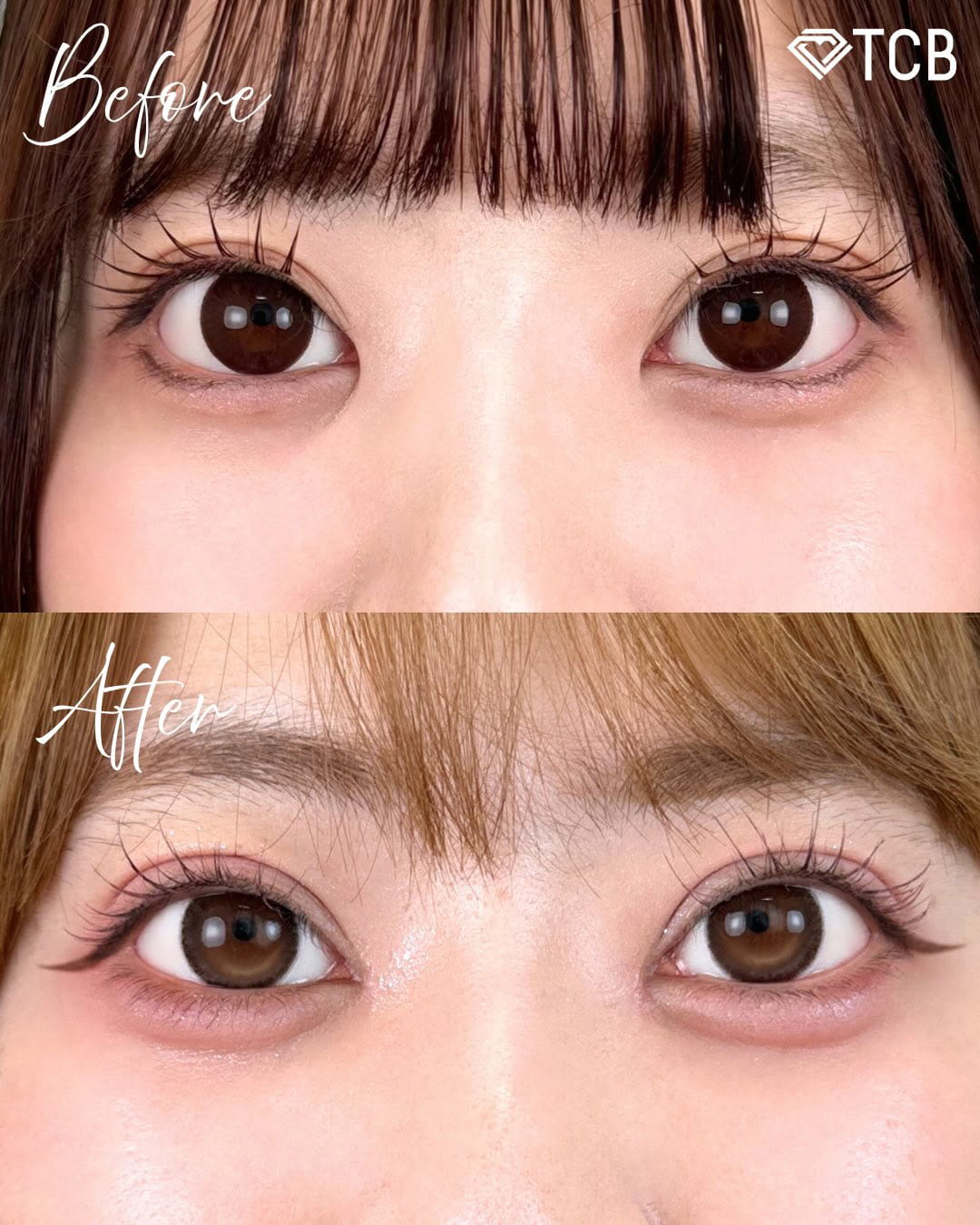 二重埋没の症例写真02