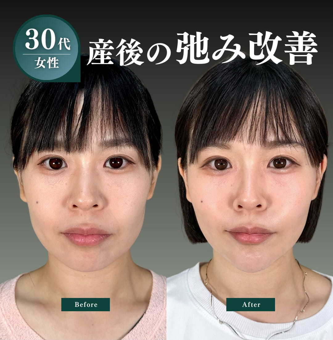 小顔美肌再生の症例写真01