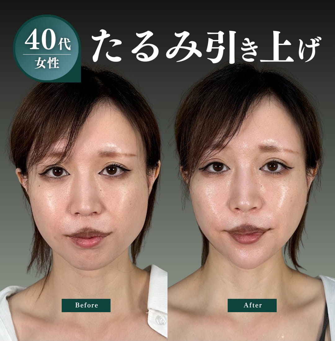 小顔美肌再生の症例写真02