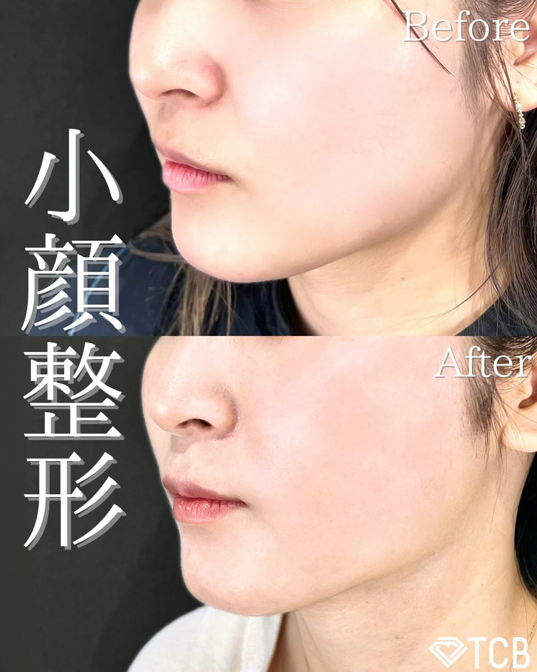 小顔美肌再生の症例写真03