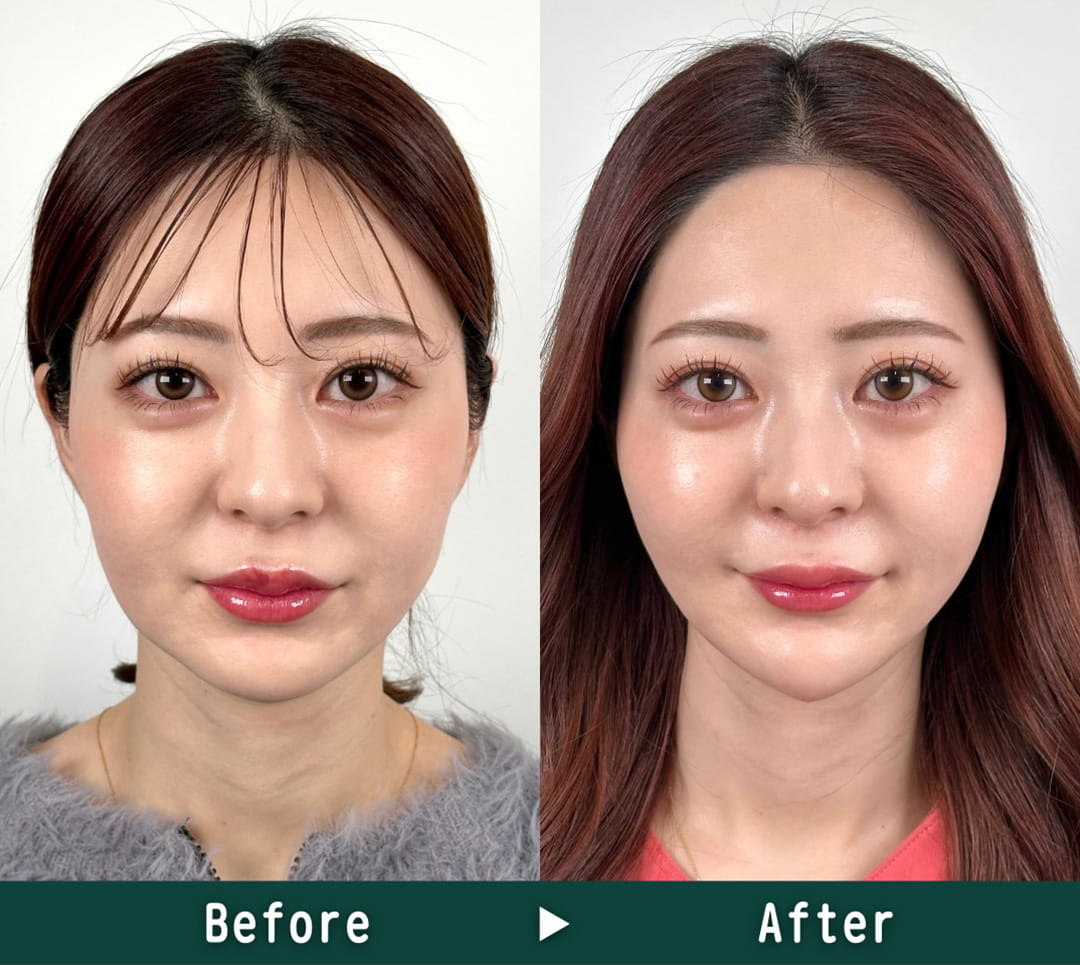 顔の脂肪吸引の症例写真01