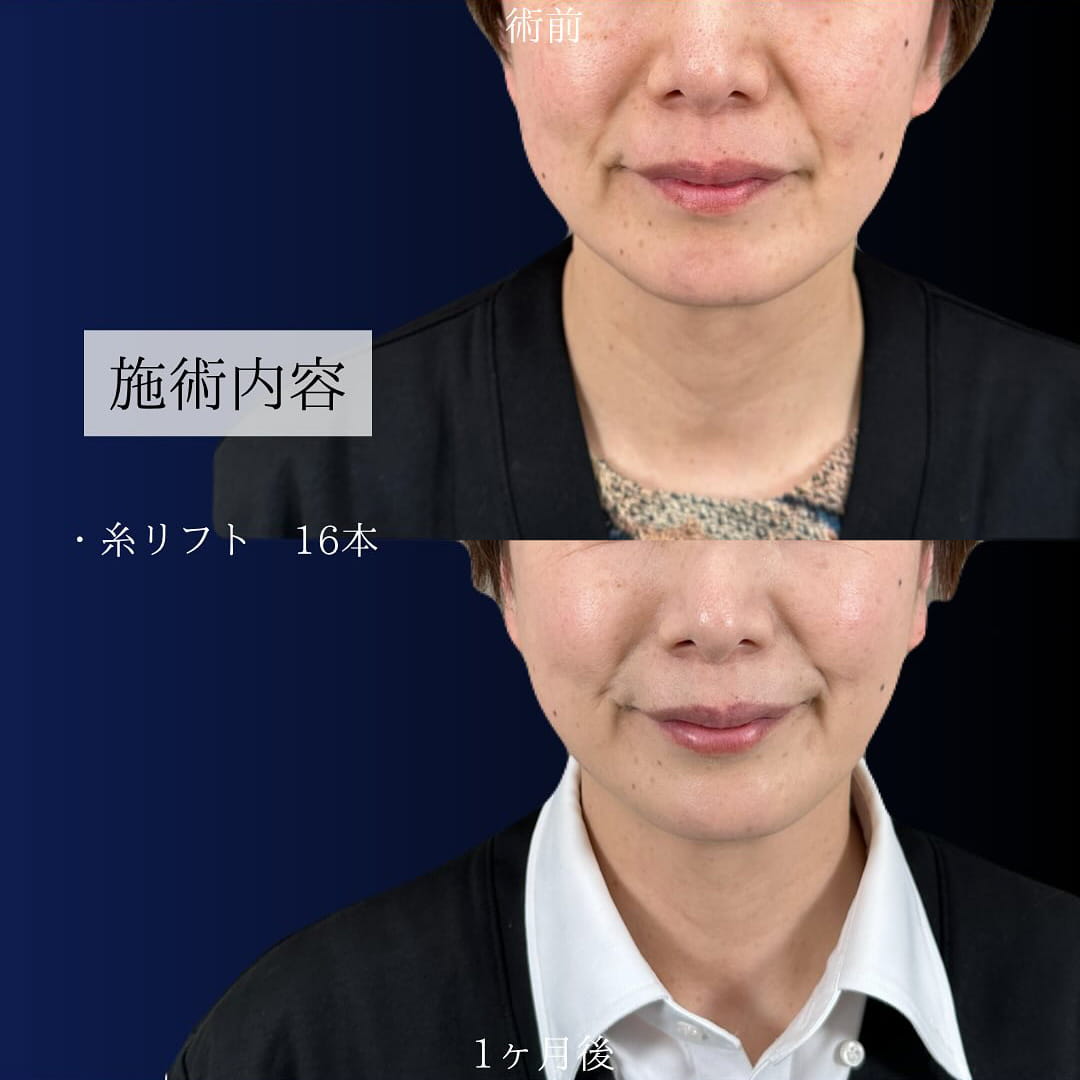 TCB小顔リフト（糸リフト・スレッドリフト）の症例写真01