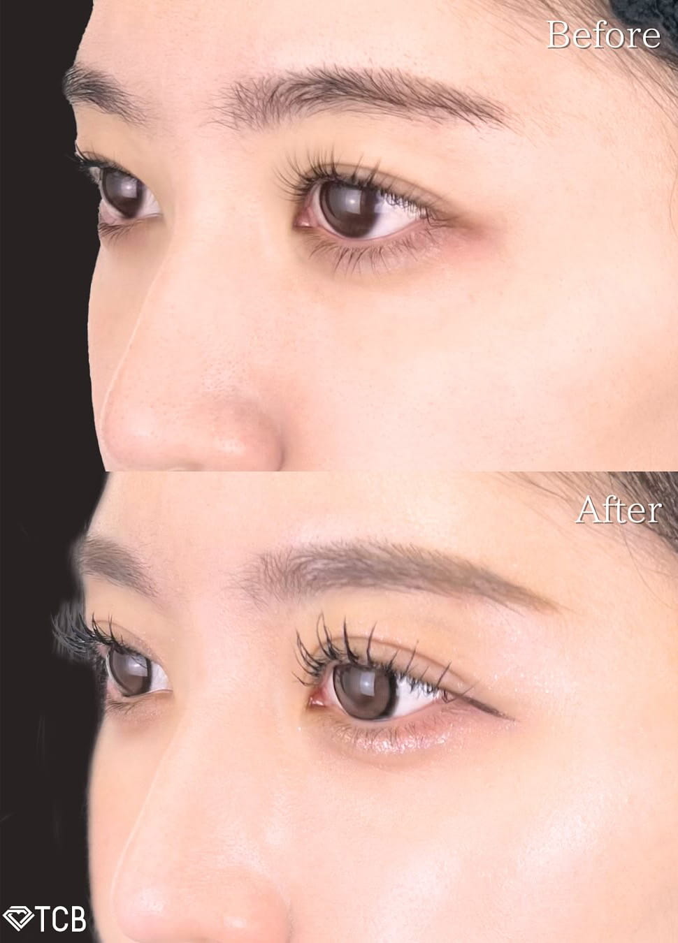 二重埋没の症例写真01