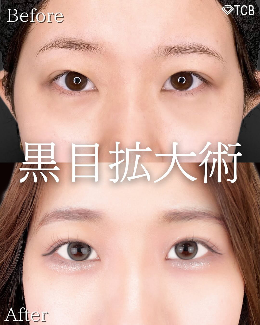 二重埋没の症例写真02