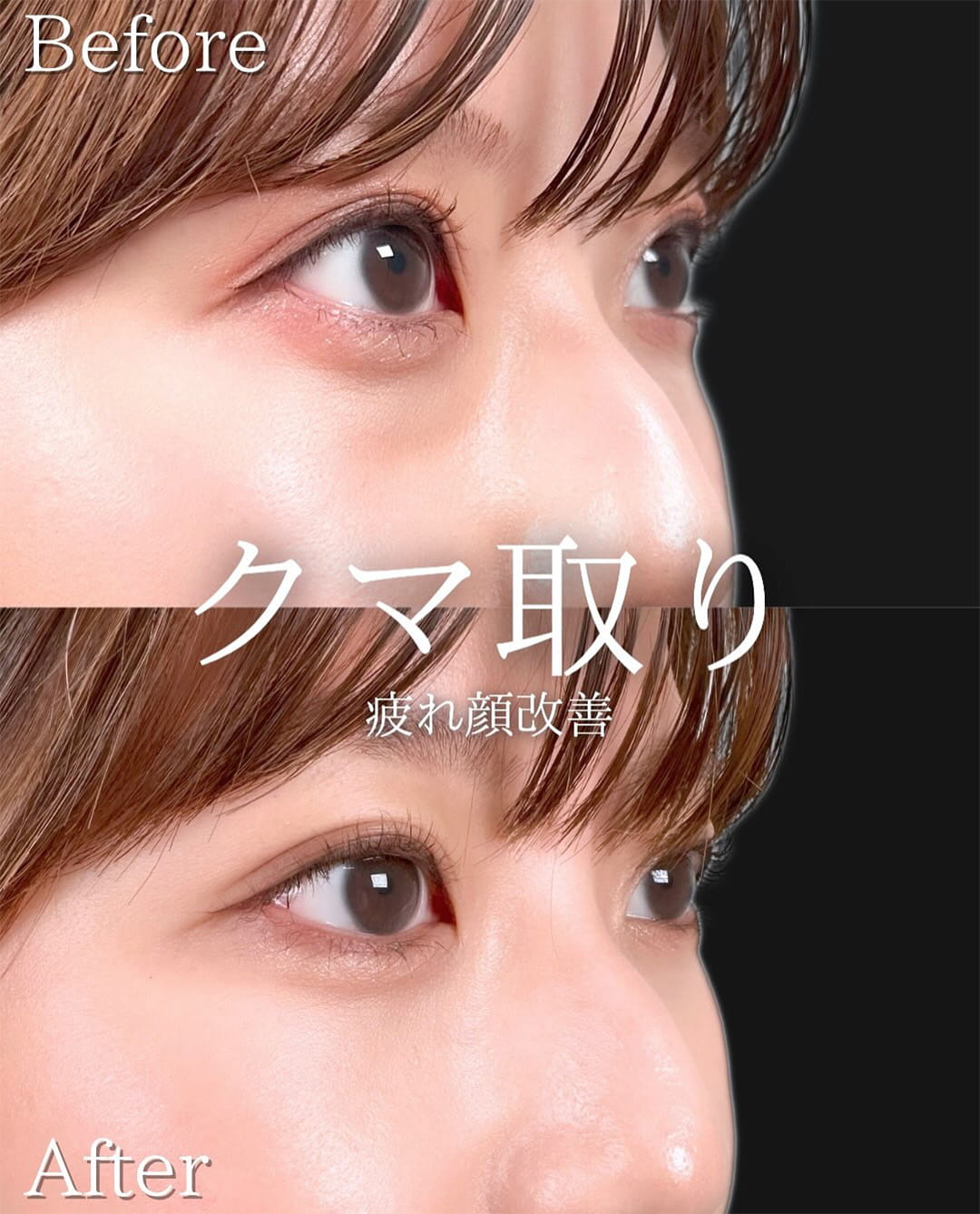 切らない目の下のクマ取り・目の下のたるみ（ふくらみ）取りの症例写真01