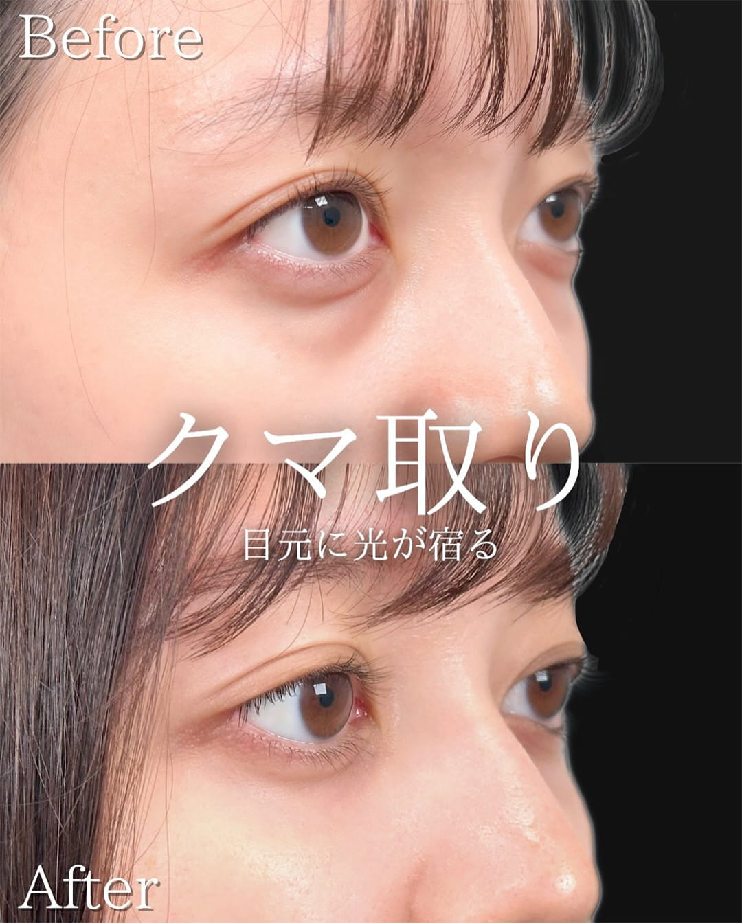 切らない目の下のクマ取り・目の下のたるみ（ふくらみ）取りの症例写真02