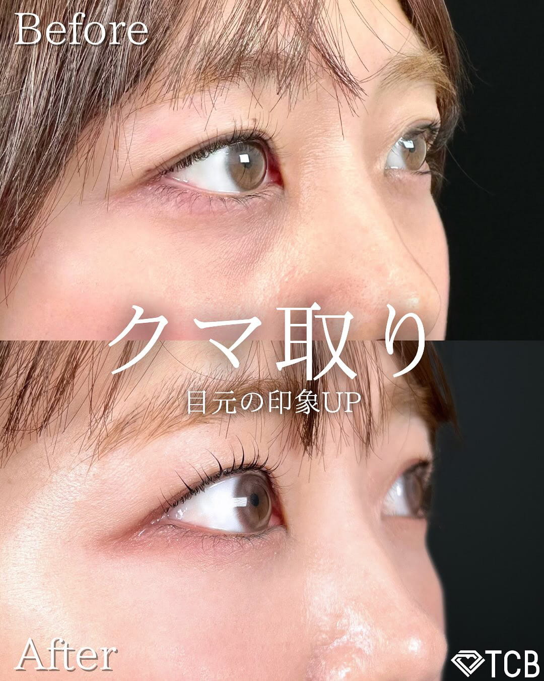 切らない目の下のクマ取り・目の下のたるみ（ふくらみ）取りの症例写真03