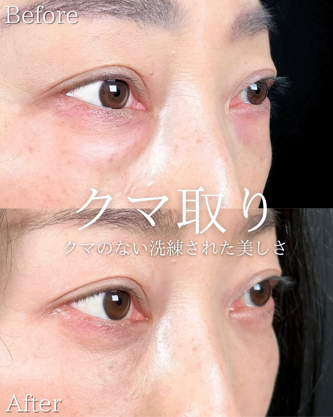 切らない目の下のクマ取り・目の下のたるみ（ふくらみ）取りの症例写真04