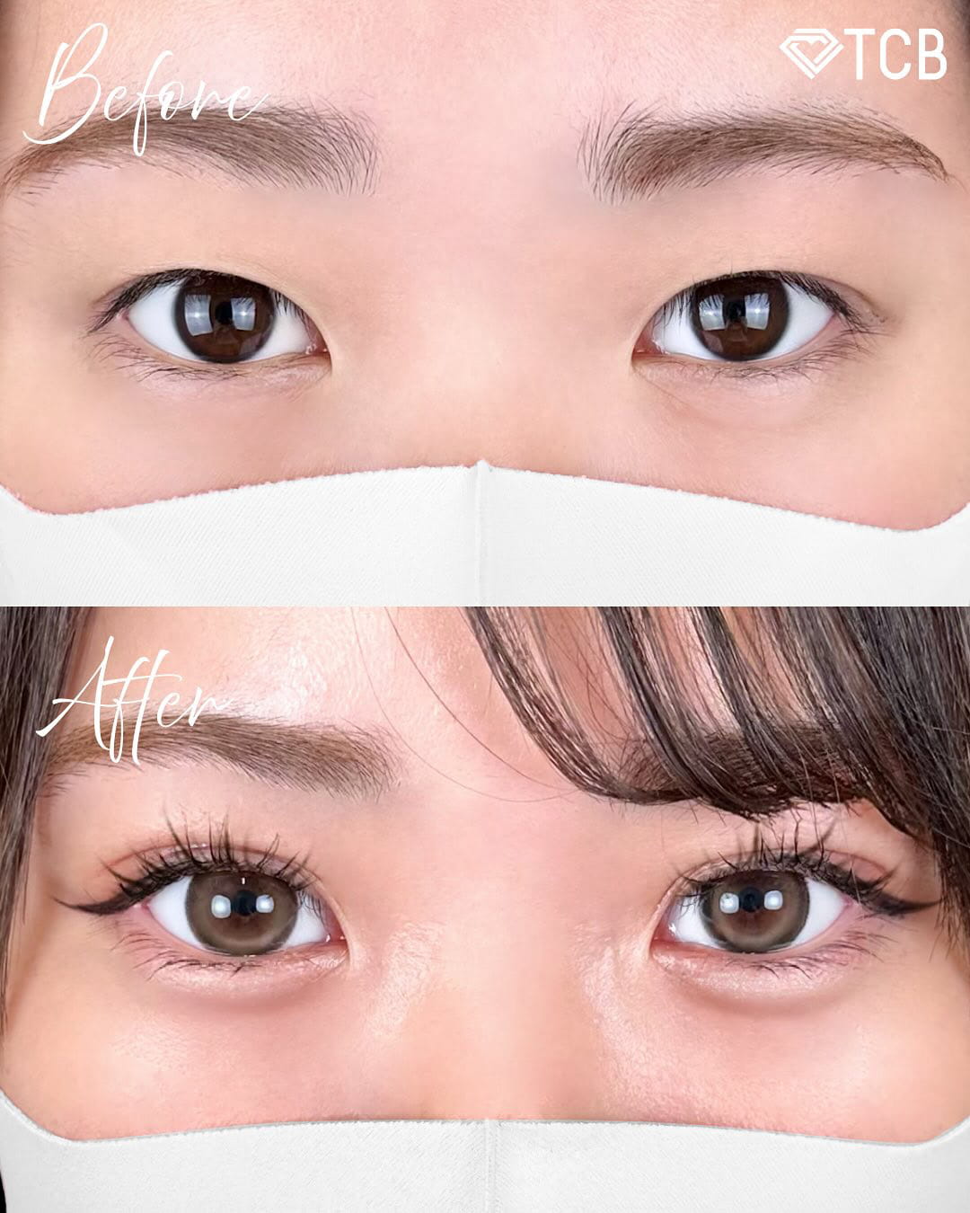 二重埋没の症例写真01