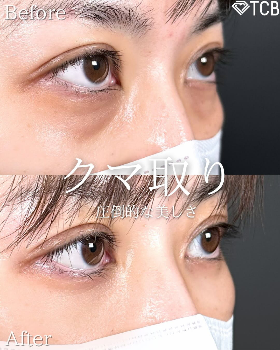 切らない目の下のクマ取り・目の下のたるみ（ふくらみ）取りの症例写真01