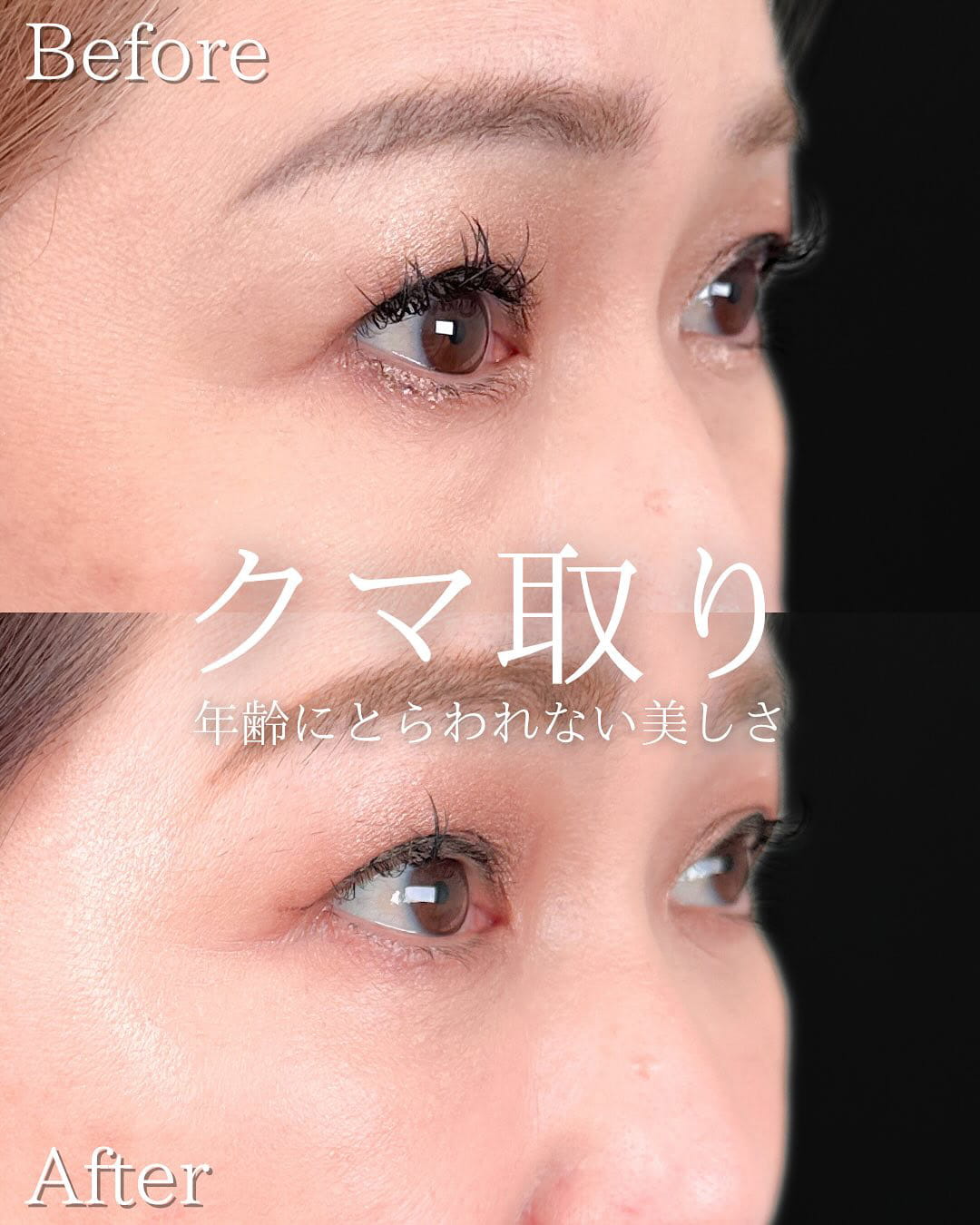 切らない目の下のクマ取り・目の下のたるみ（ふくらみ）取りの症例写真02