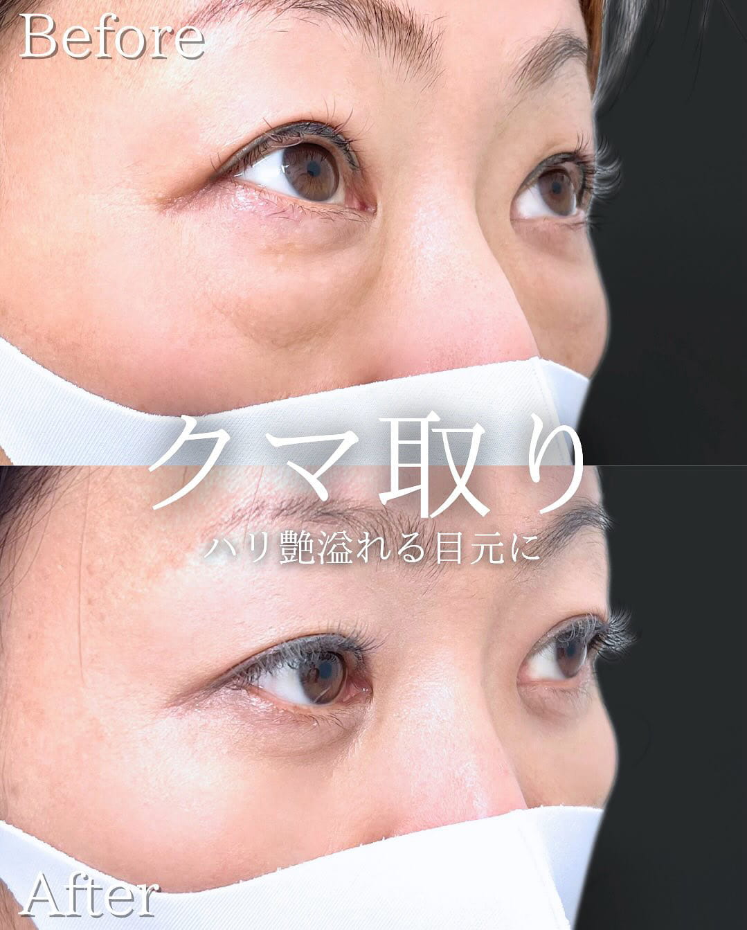 切らない目の下のクマ取り・目の下のたるみ（ふくらみ）取りの症例写真03