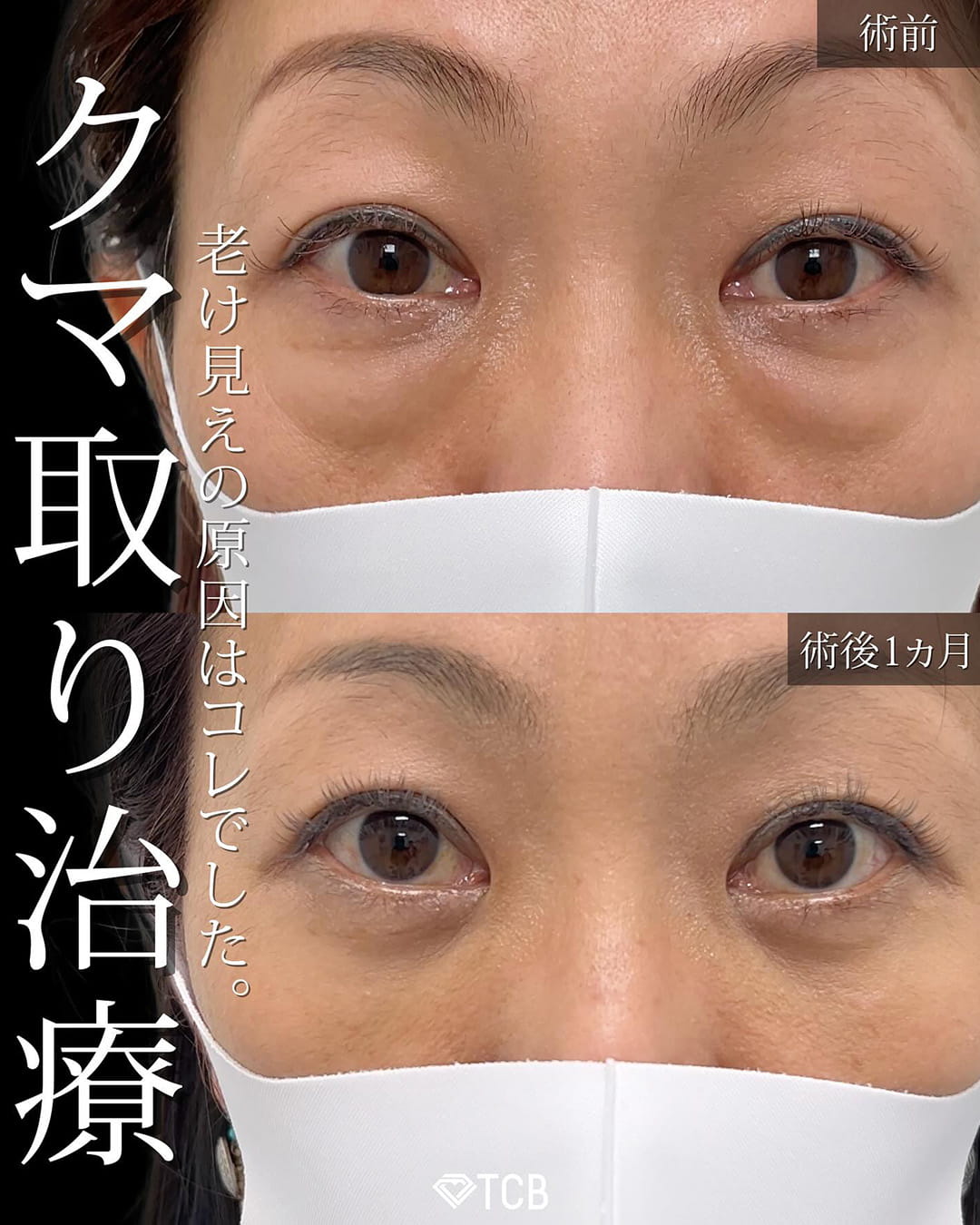 切らない目の下のクマ取り・目の下のたるみ（ふくらみ）取りの症例写真04