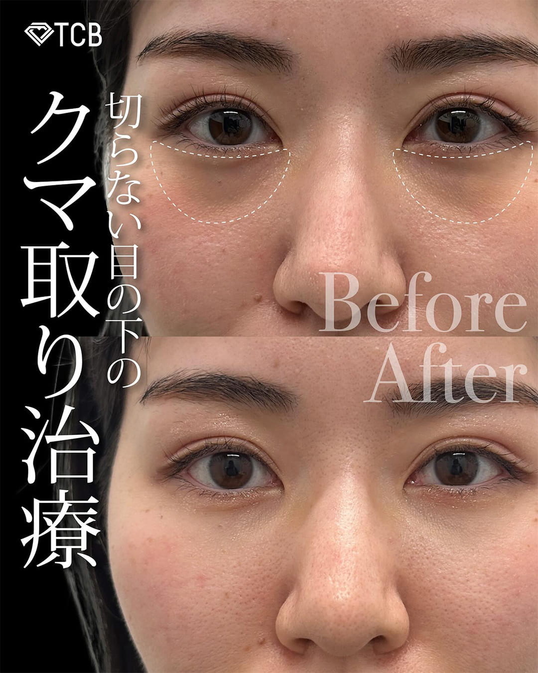 切らない目の下のクマ取り・目の下のたるみ（ふくらみ）取りの症例写真05
