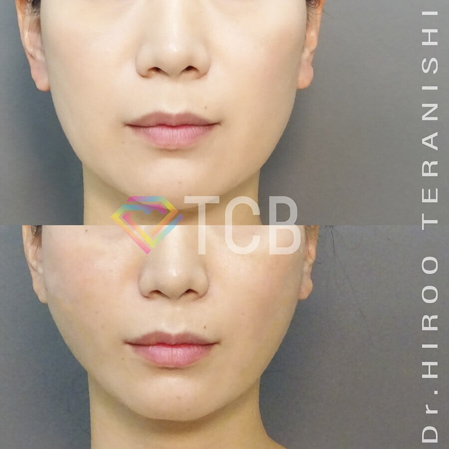 小顔美肌再生の症例写真02