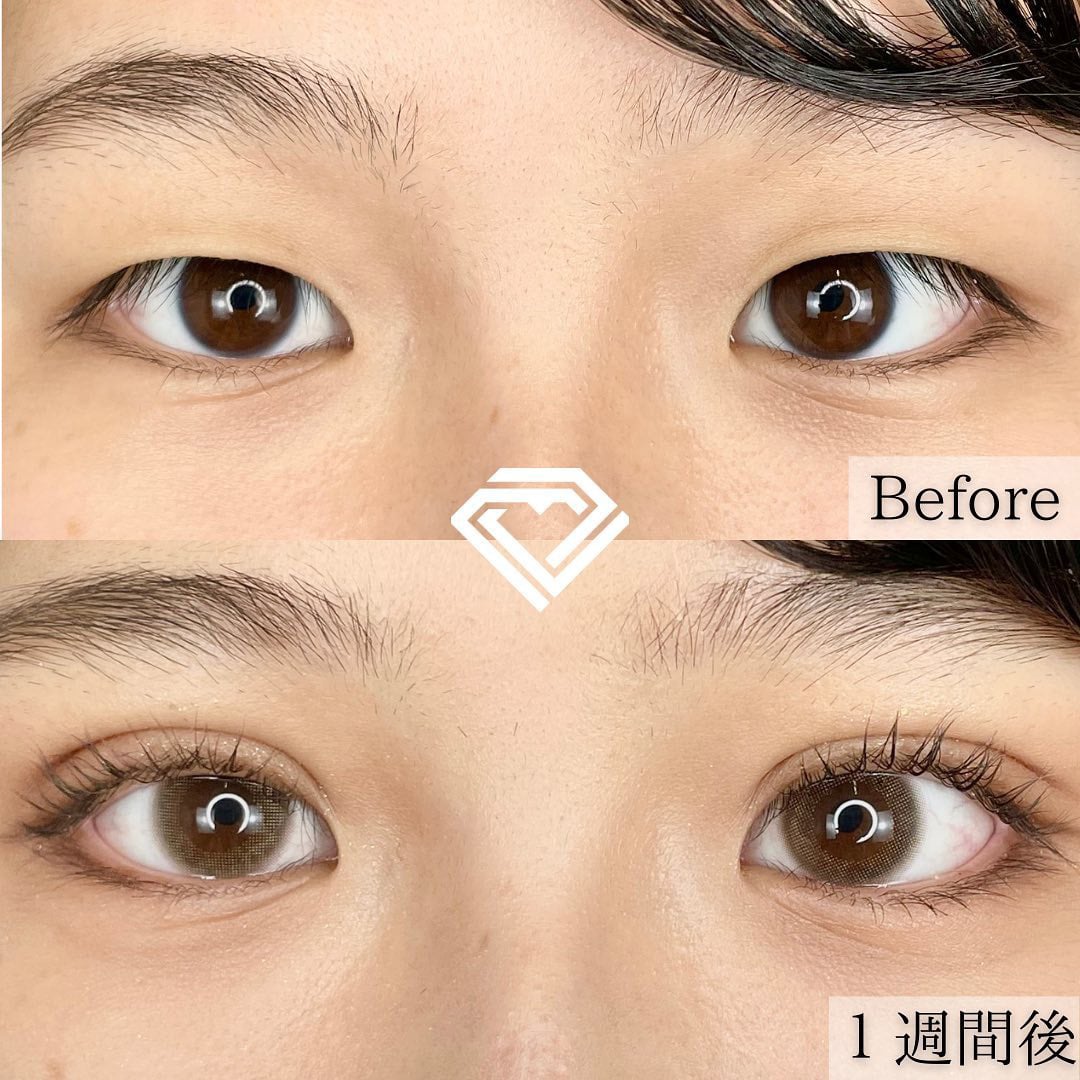 二重埋没の症例写真01