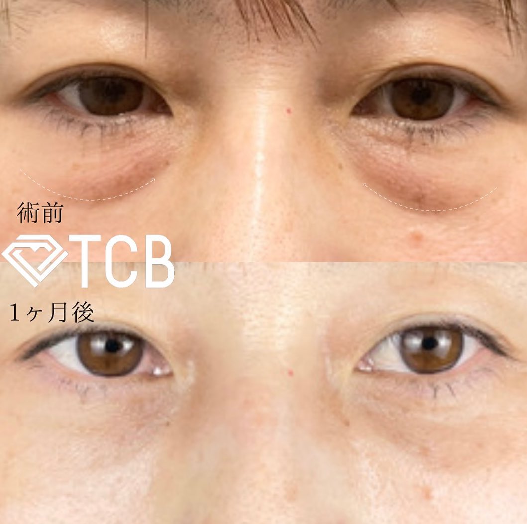 皮膚を切らない目の下のクマ取り・たるみ（ふくらみ）取りの症例写真01