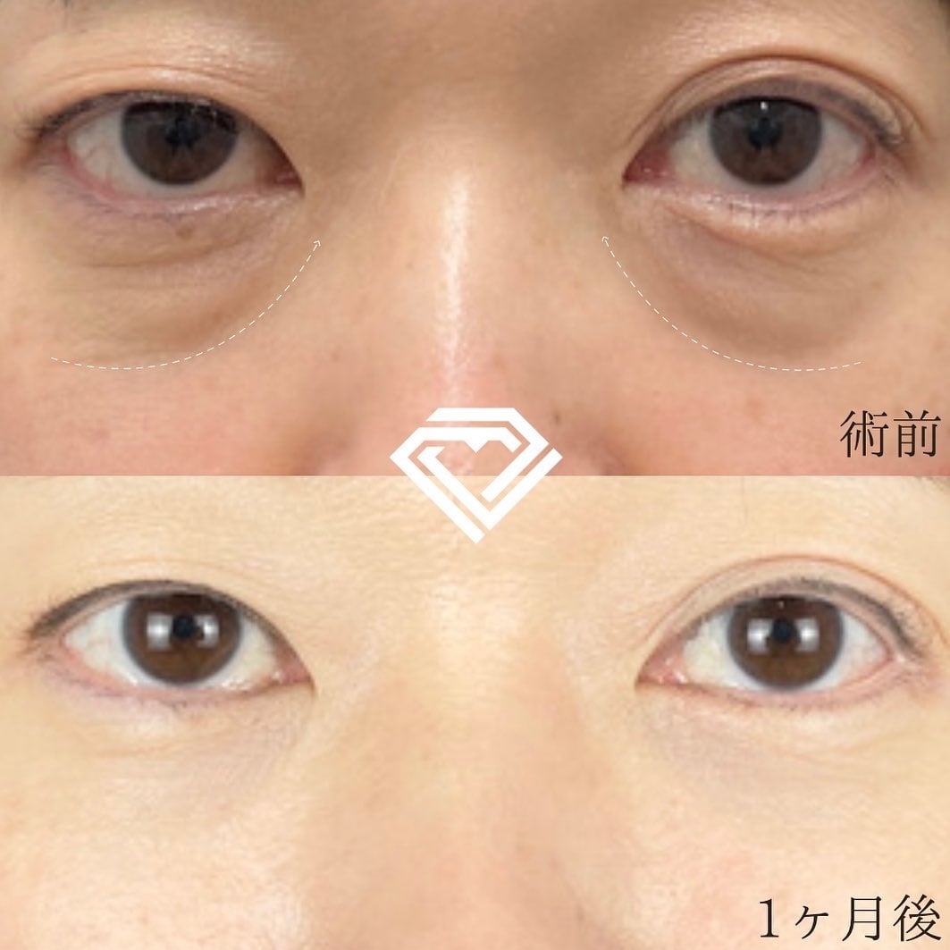 皮膚を切らない目の下のクマ取り・たるみ（ふくらみ）取りの症例写真02