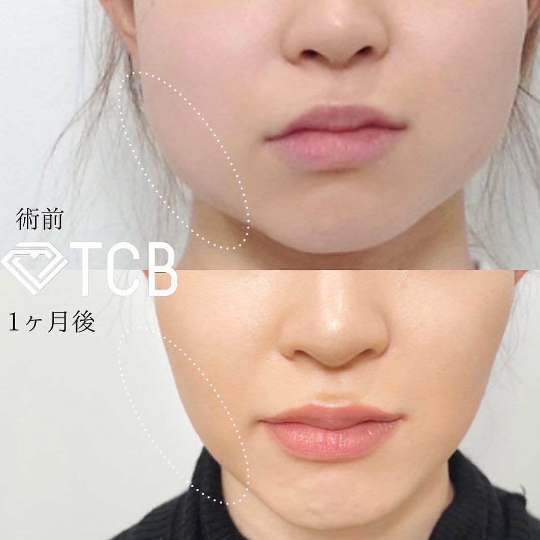 小顔美肌再生の症例写真01