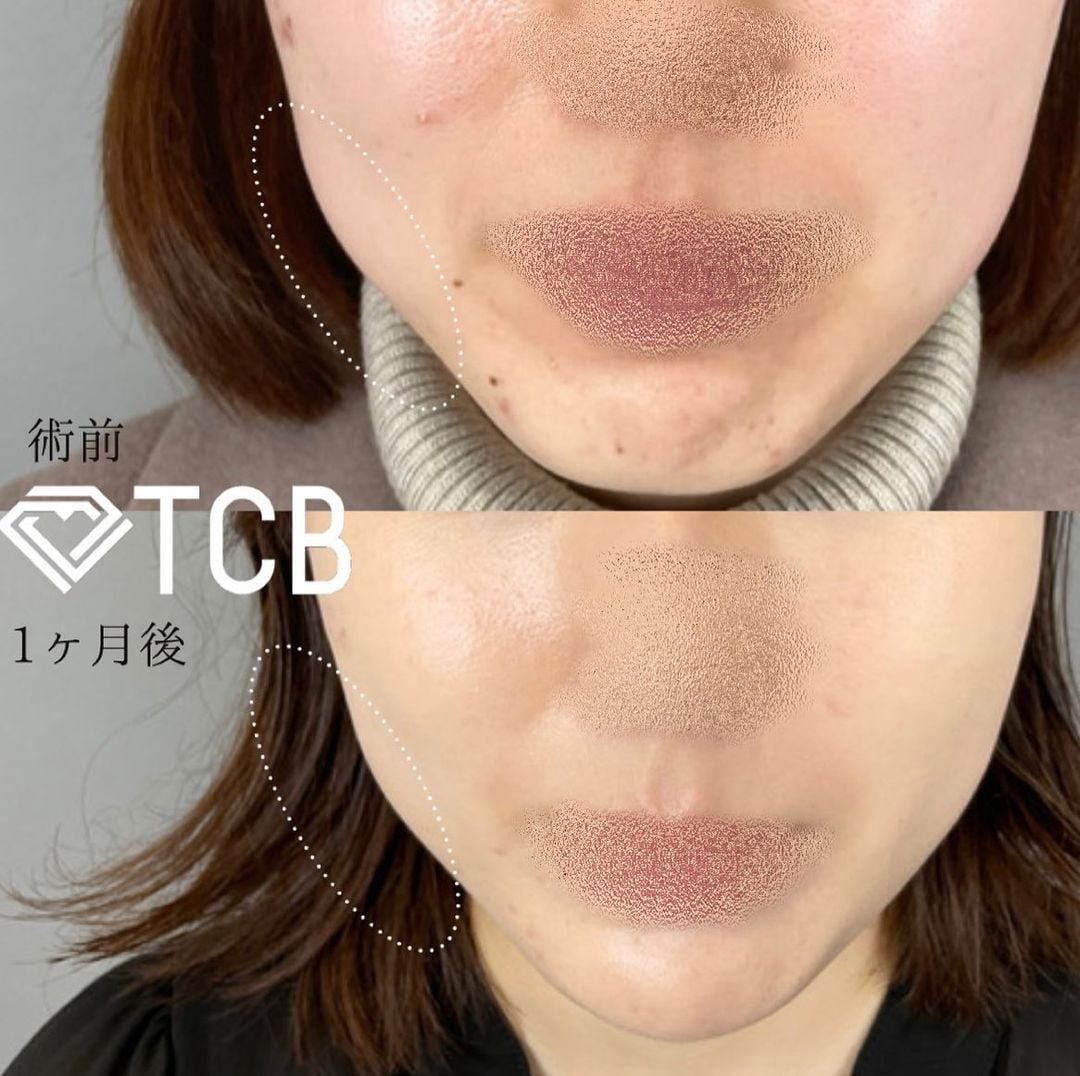 小顔美肌再生の症例写真02