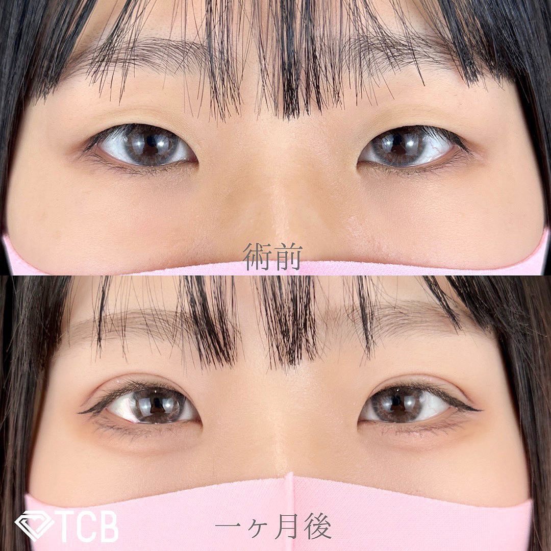 二重埋没の症例写真01