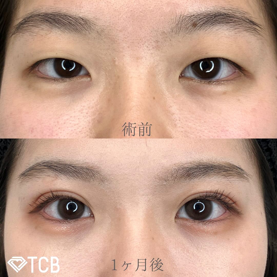 二重埋没の症例写真02