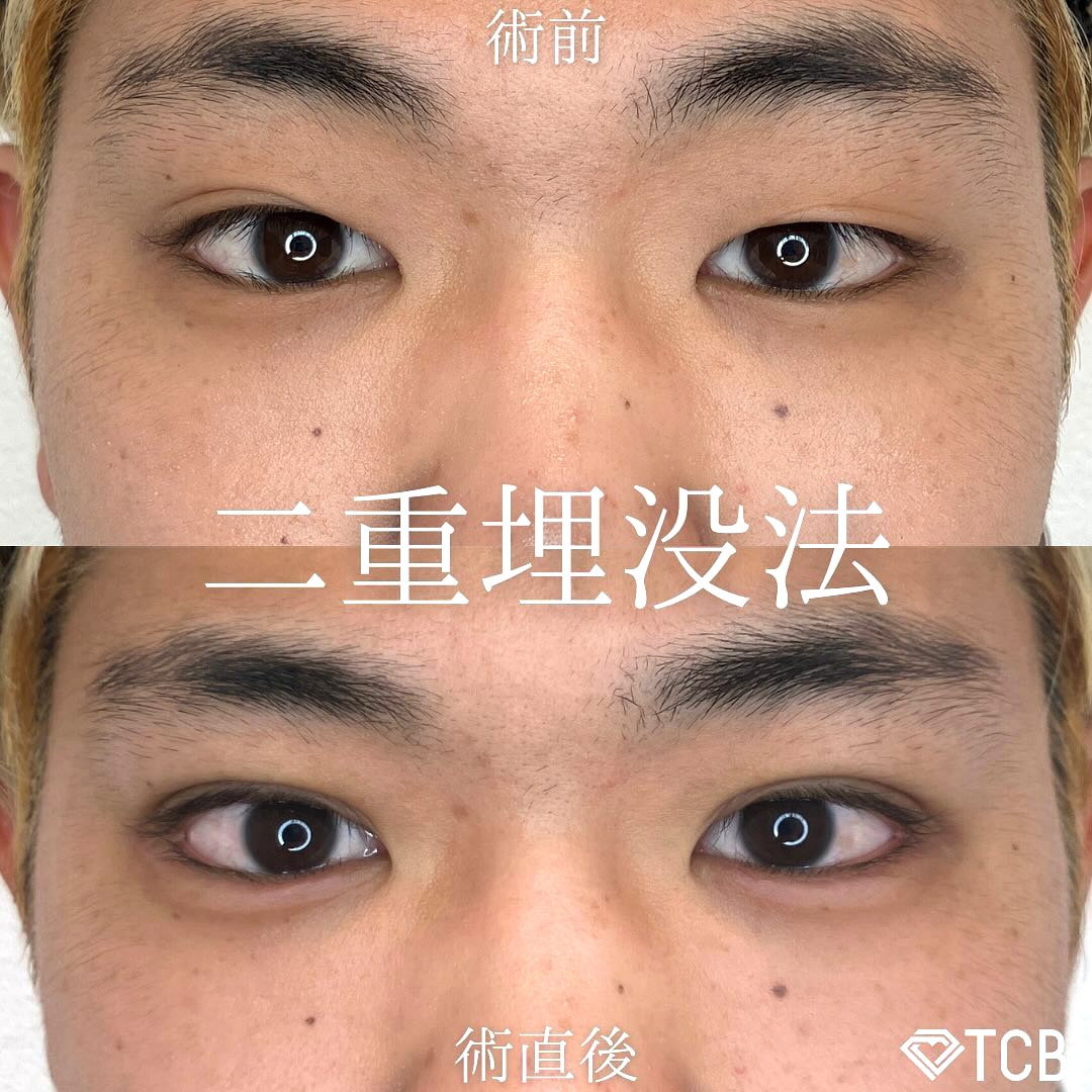 二重埋没の症例写真03