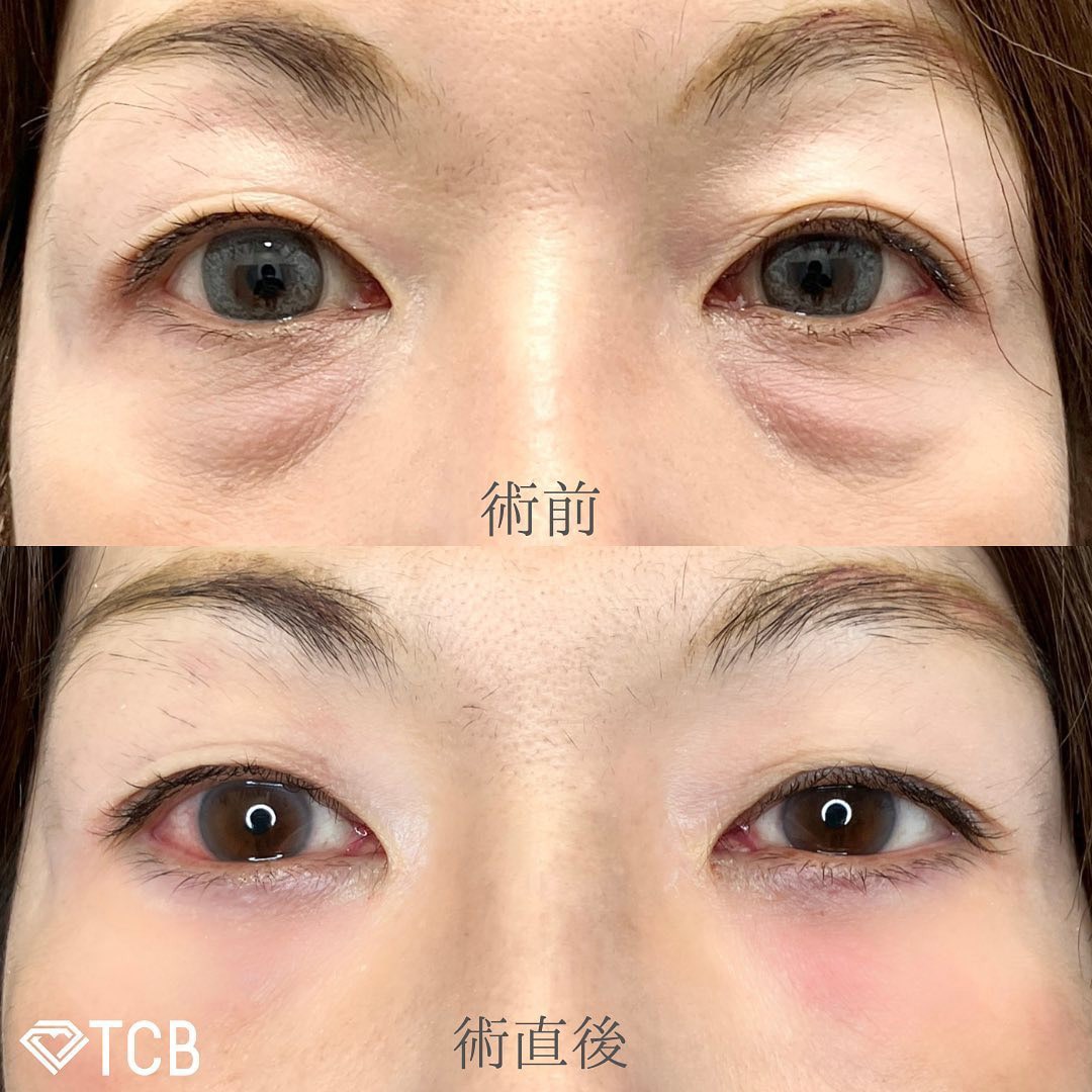 切らない目の下のクマ取り・たるみ（ふくらみ）取りの症例写真01