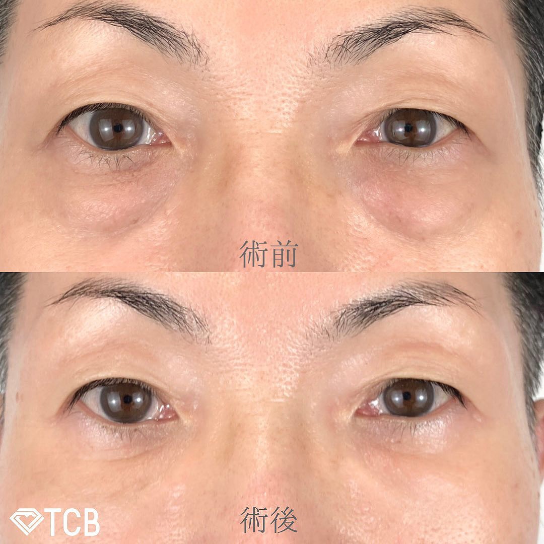 切らない目の下のクマ取り・たるみ（ふくらみ）取りの症例写真02