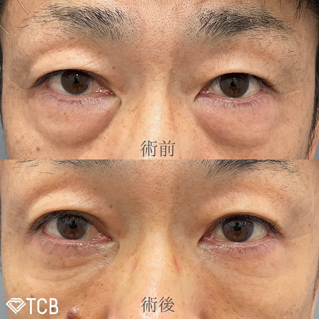 切らない目の下のクマ取り・たるみ（ふくらみ）取りの症例写真03