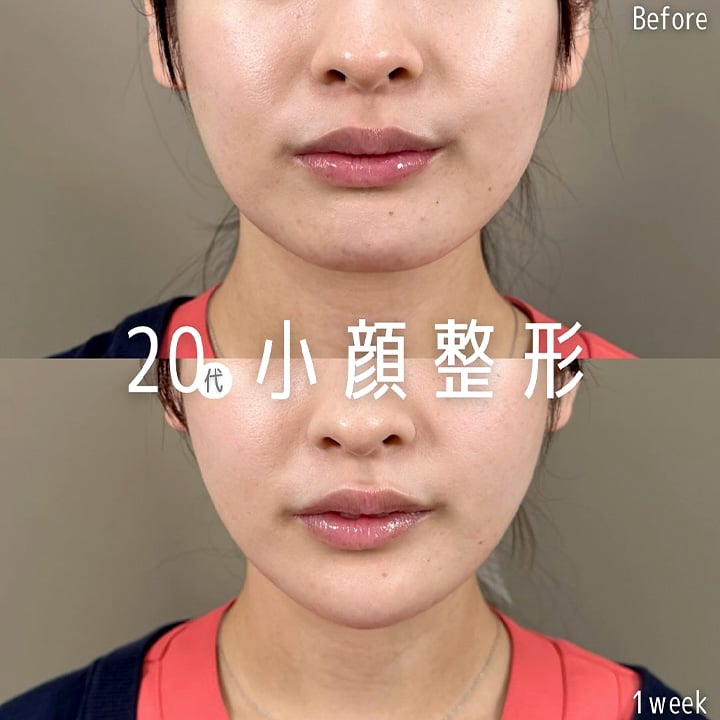 小顔美肌再生の症例写真01