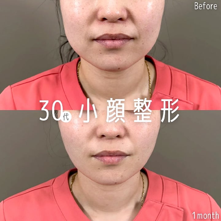小顔美肌再生の症例写真02