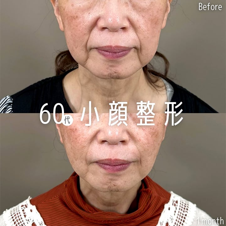 小顔美肌再生の症例写真03