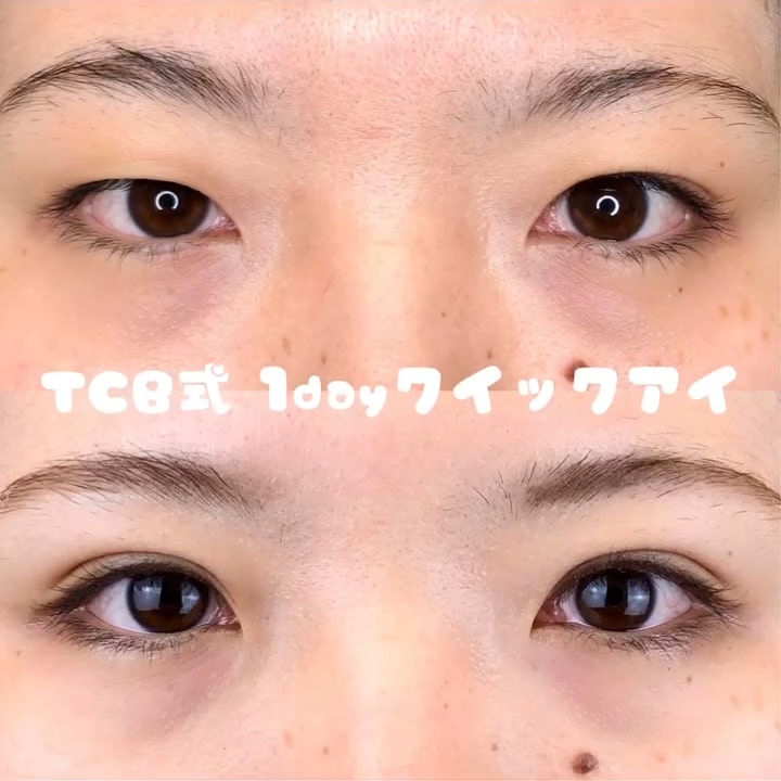 二重埋没の症例写真04