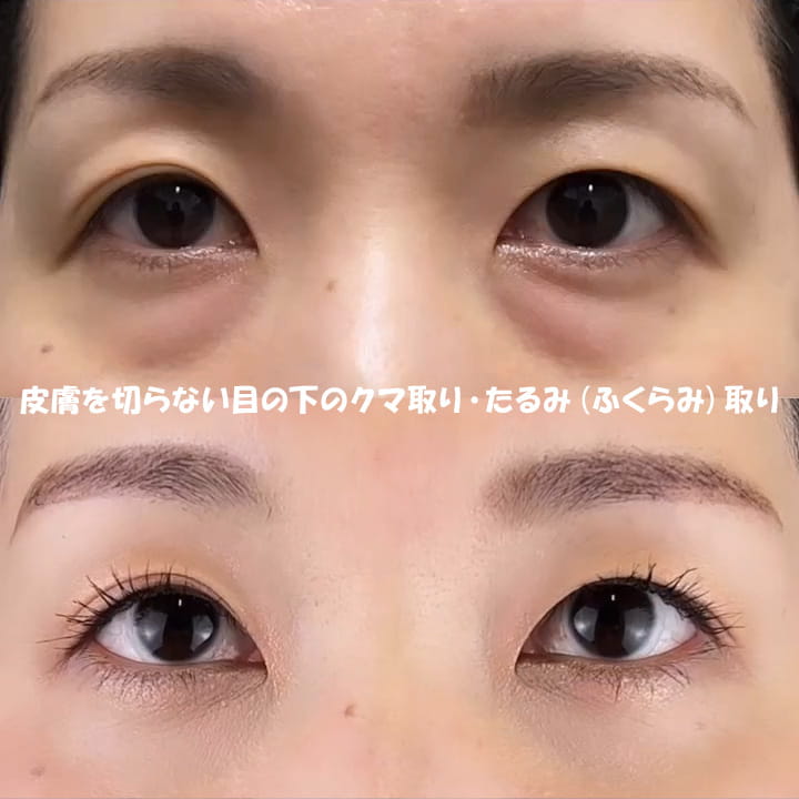 皮膚を切らない目の下のクマ取り・たるみ（ふくらみ）取りの症例写真01