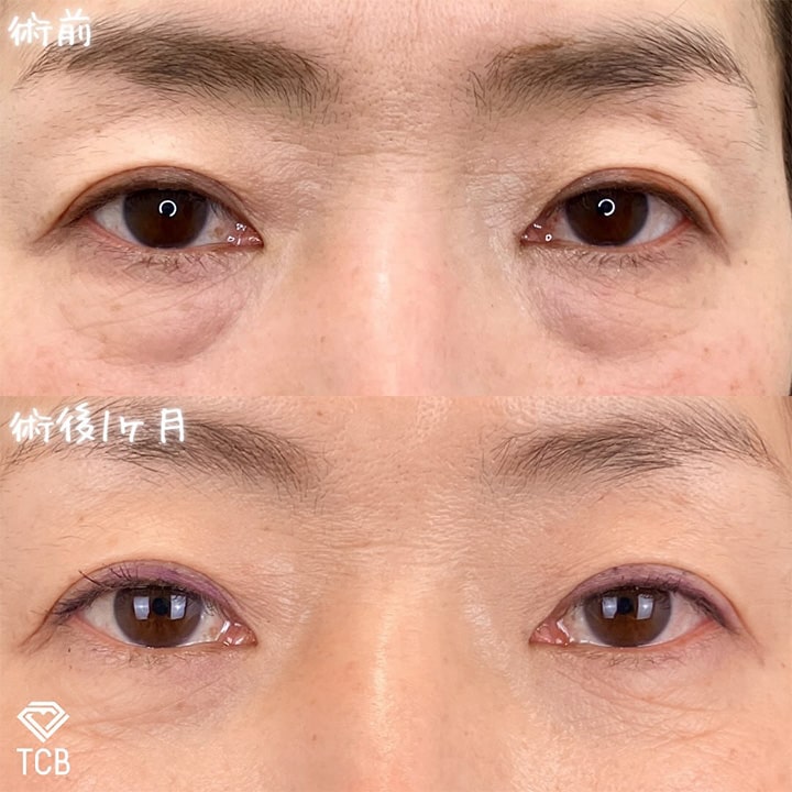 皮膚を切らない目の下のクマ取り・たるみ（ふくらみ）取りの症例写真02