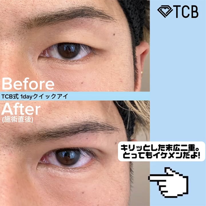 二重埋没の症例写真01