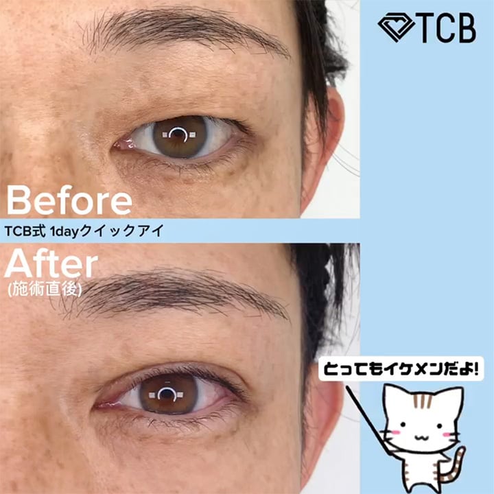 二重埋没の症例写真02