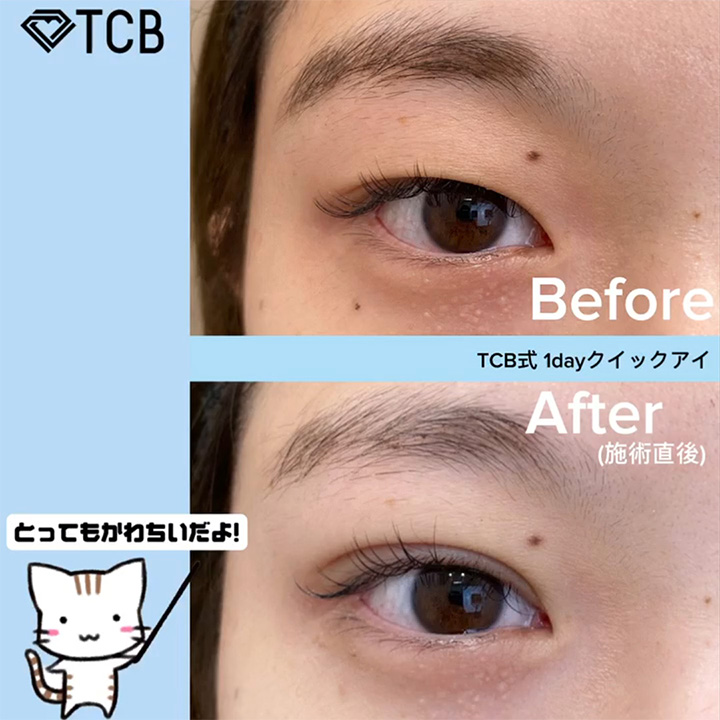 二重埋没の症例写真03