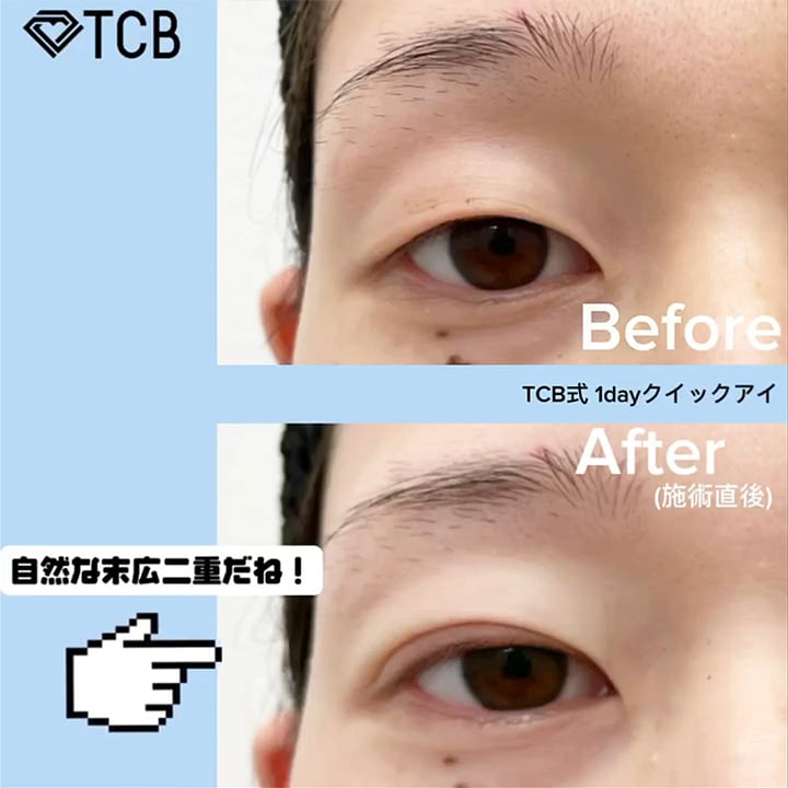 二重埋没の症例写真04