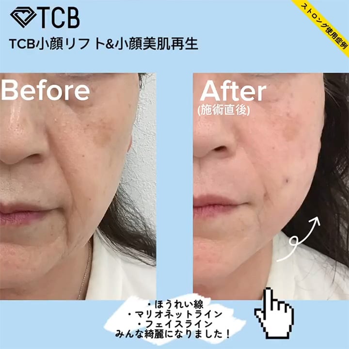 小顔美肌再生の症例写真01